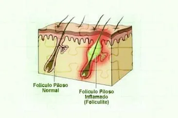 foliculite