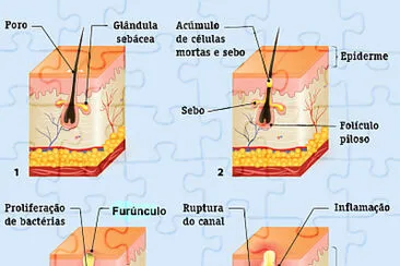 Furunculo jigsaw puzzle