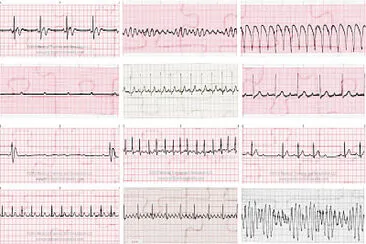 פאזל של Ritmos electrocardiograficos