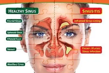 פאזל של sinusitis