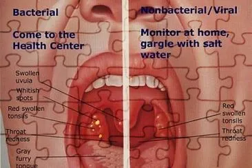 faringitis jigsaw puzzle