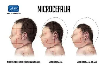 Microcefalia.