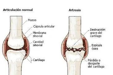 Atrosis