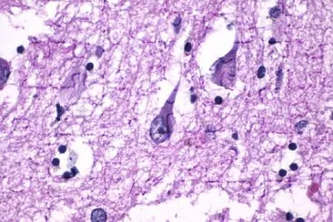 פאזל של Histopathology of Neurofibrillary Tangles