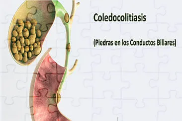 Coledocolitiasis