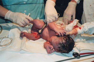 NEONATOLOGÃA.